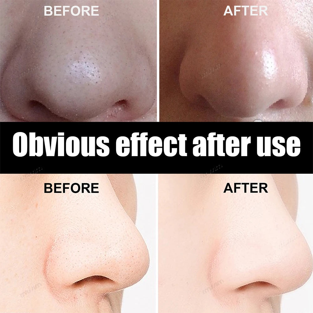 Blackhead Remover Nasal Strips