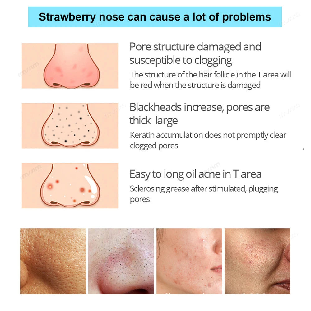 Blackhead Remover Nasal Strips